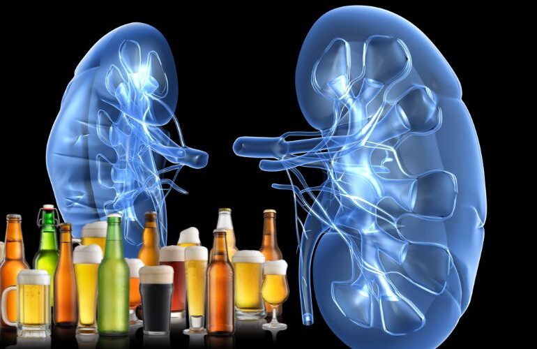 Is beer good for removing kidney stone
